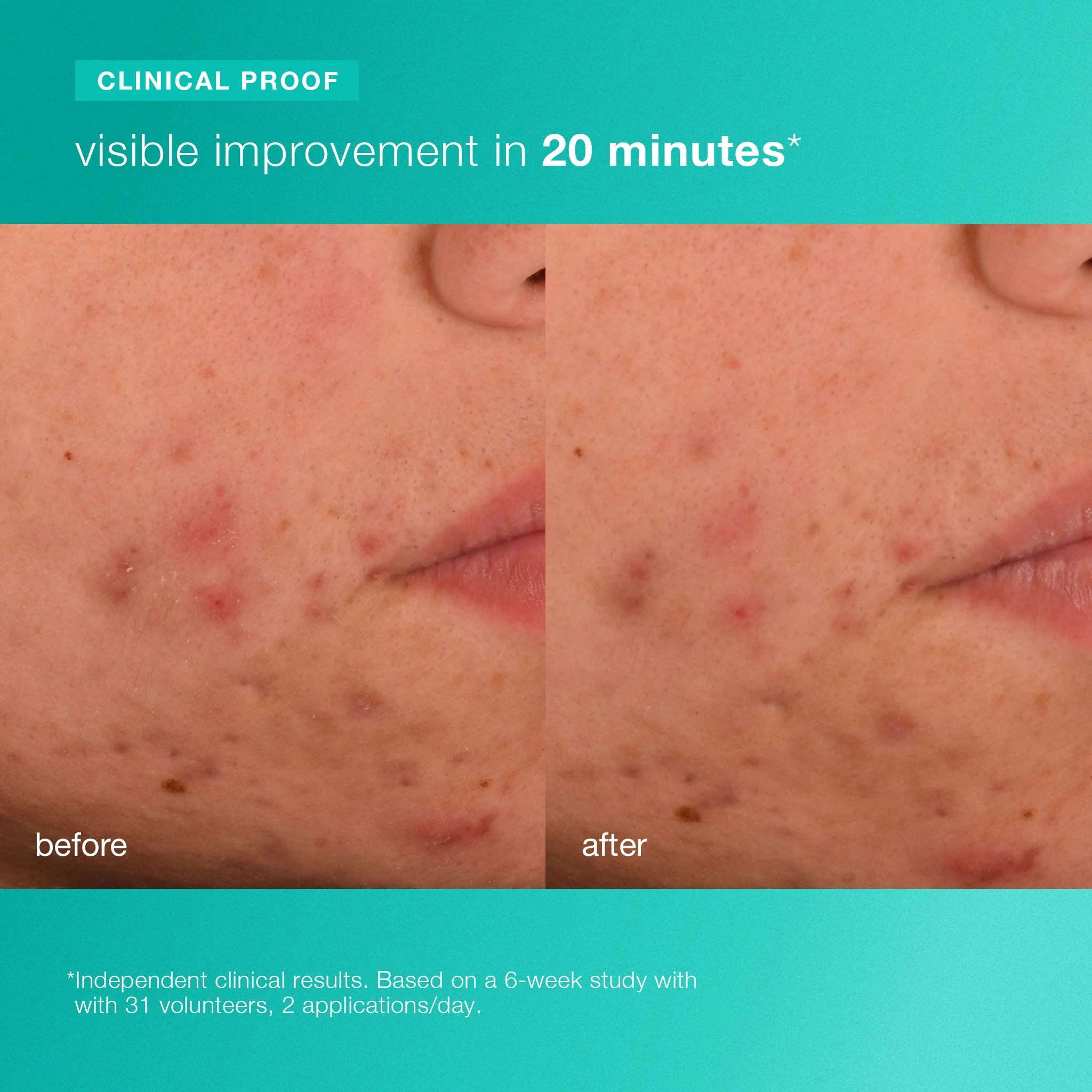 acne biotic moisturizer - Image 4