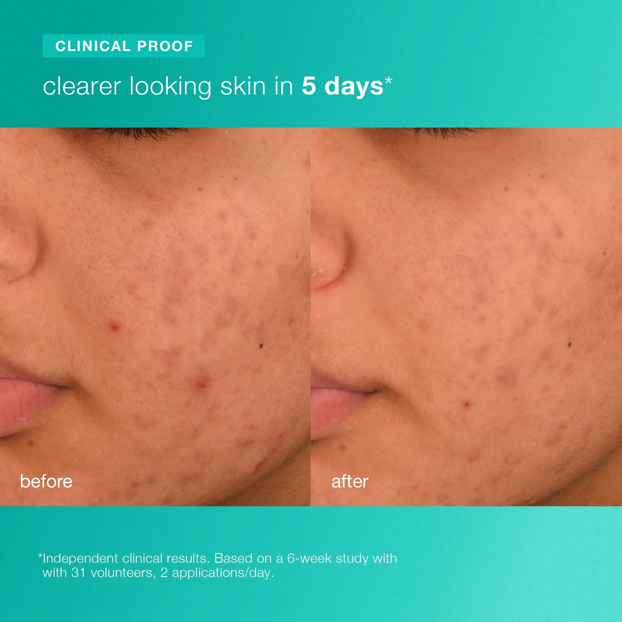 acne biotic moisturizer - Image 5