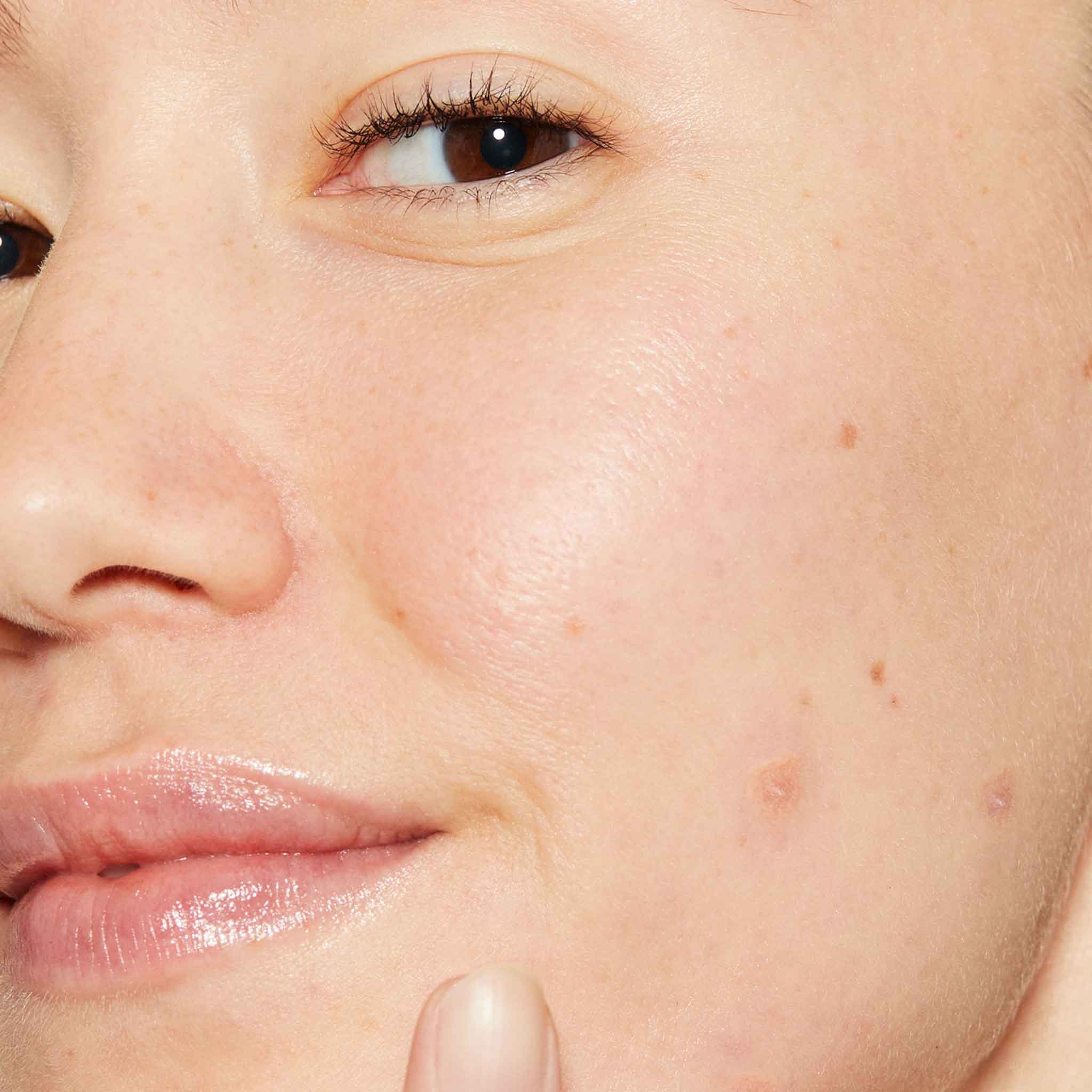 deep acne invisible liquid patch - Image 3